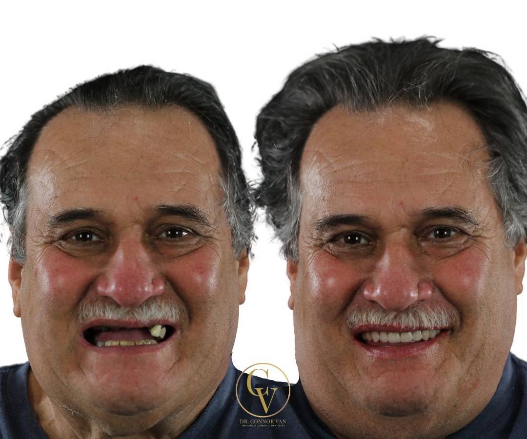 Dr. Connor Van Before & After Dental Implant Photo 1