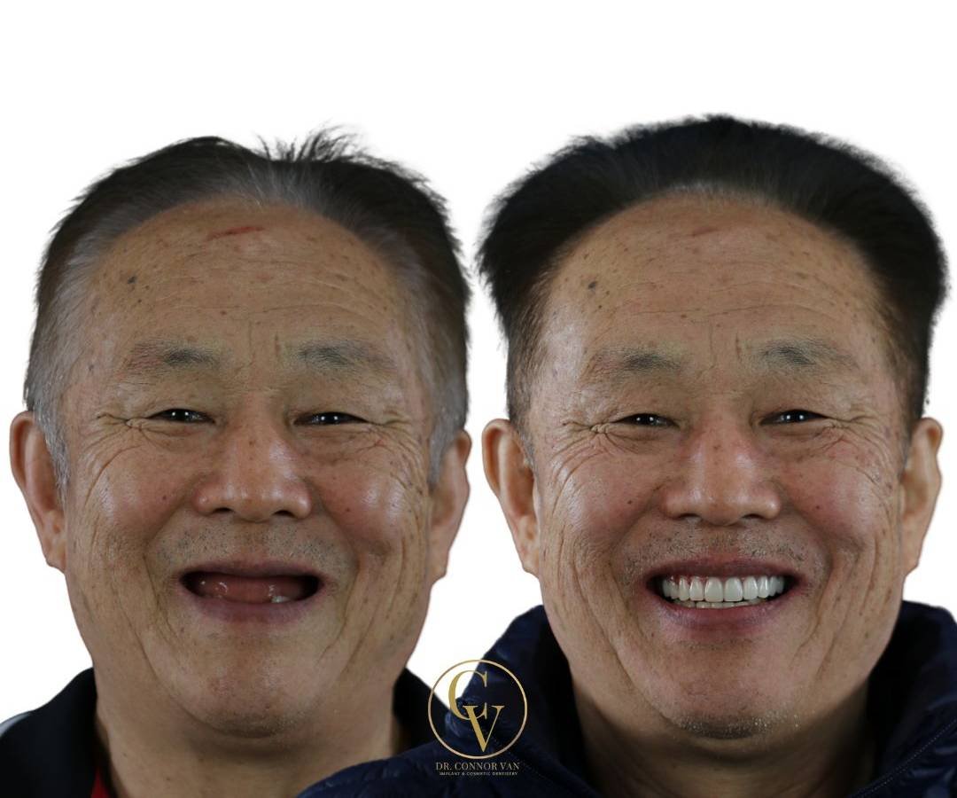 Ormond Dental Implants Dental Implant Transformation