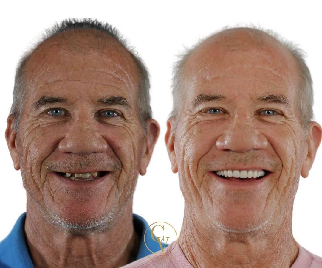 Ormond Dental Implants Dental Implant Transformation Photo 6