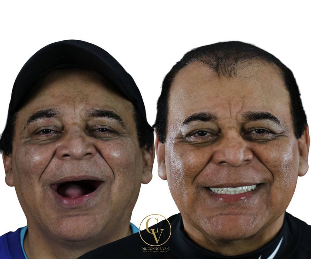 Ormond Dental Implants Before & After Dental Implant Photo 8