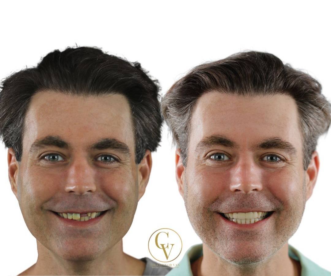 Ormond Dental Implants Dental Implant Before and After