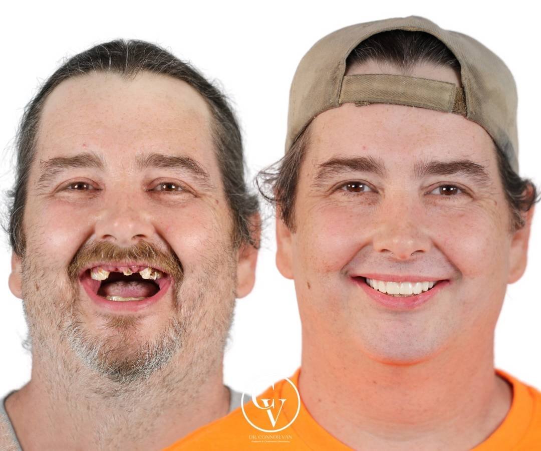 Dr. Connor Van Before & After Dental Implant Photo 12