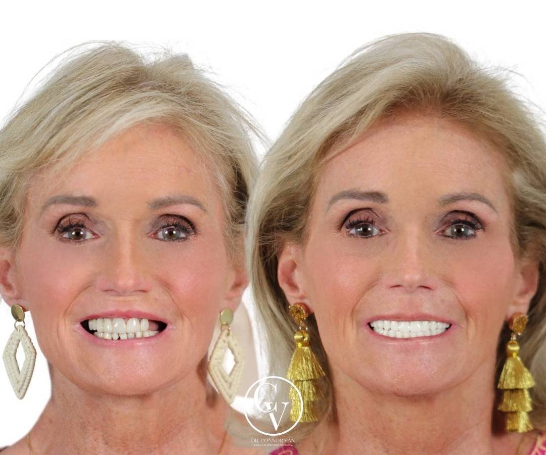 Ormond Dental Implant Success Photo 16 by Ormond Dental Implants