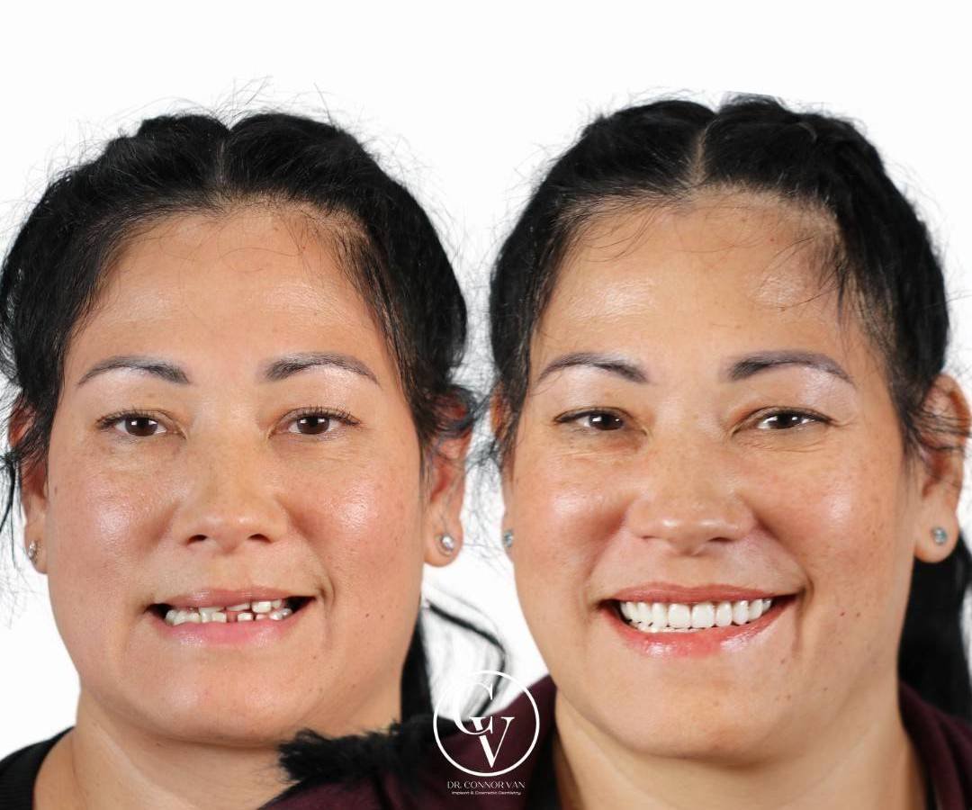 Ormond Dental Implants Dental Implant Before & After Result 17